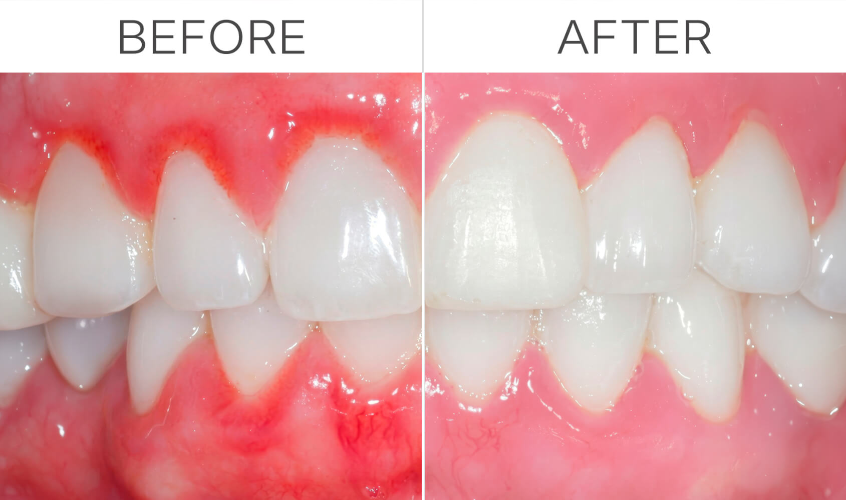 Dentists Warn: Your Toothbrush (Electric or Regular) Is Damaging Your Gums — This New Bioelectric Brush Heals Them Instead