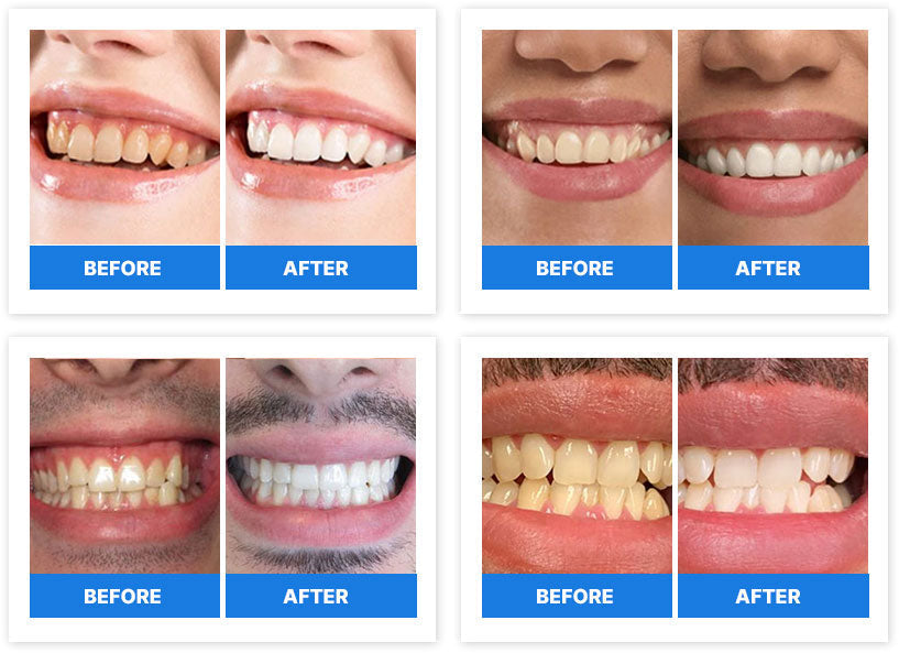 Hiding Your Smile Is Not the Answer — This Revolutionary New Formula Whitens Teeth With No Pain, No Mess and No Complicated Routine